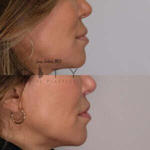 Lip Lift Revision Case 4 | NYC Lip Lift Revision Surgery