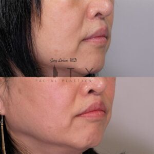 Lip Lift Revision Case 3 | NYC Lip Lift Revision Surgery