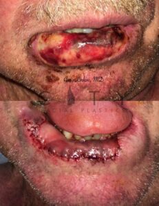 Lip Reconstruction Case 2 | NYC Lip Reconstruction Surgery, New York Lip Trauma Repair