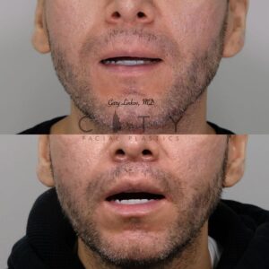 Male Plastic Surgery Lip Lift Case 2 | NYC City Facial Plastics