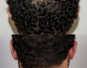 Male Plastic Surgery Otoplasty Case 1 | NYC City Facial Plastics