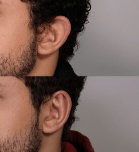 Male Plastic Surgery Otoplasty Case 1 | NYC City Facial Plastics