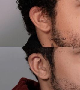 Male Plastic Surgery Otoplasty Case 1 | NYC City Facial Plastics