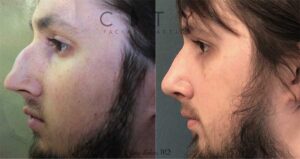 Male Plastic Surgery Rhinoplasty Case 3 | NYC City Facial Plastics