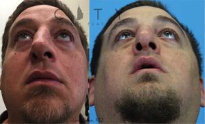 Male rhinoplasty Before and After