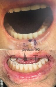 Mohs surgery repair case 2 | NYC Mohs Surgery, New York Skin Cancer Plastic Surgeon