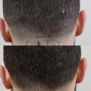 Mole Removal Case 1 | NYC Mole Removal Plastic Surgeon, New York Nevus Treatment