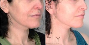 Neck Lift Case 1 | NYC Neck Lift Surgery, New York Lower Rhytidectomy
