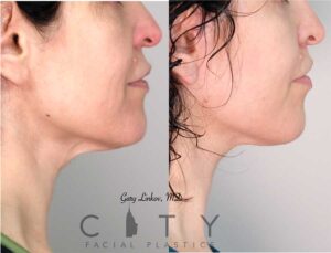 Neck Lift Case 1 | New York Lower Rhytidectomy