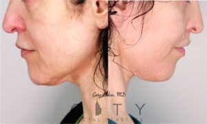 Neck Lift Case 1 | NYC Neck Lift Surgery
