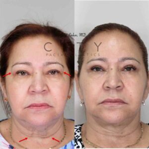 Neck Liposuction Case 1