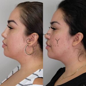 Neck Liposuction Case 2