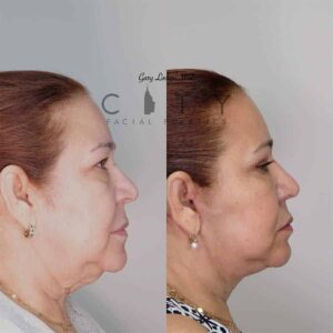 Neck Liposuction Case 1