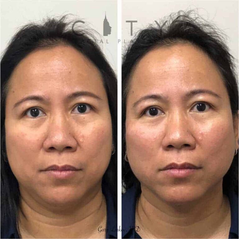 NYC NonSurgical Facelift Newest Non Surgical Facelift Options UES