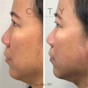 Non-surgical facelift threads Case 1 | New York Minimally Invasive Facelift
