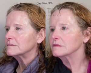 Non-surgical facelift filler/neurotoxin Case 2 | NYC Minimally Invasive Facelift