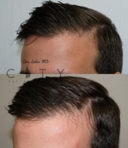 PRP for hair loss case 3 | PRP for Hair Loss, City Facial Plastics
