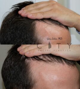 PRP for hair loss case 2