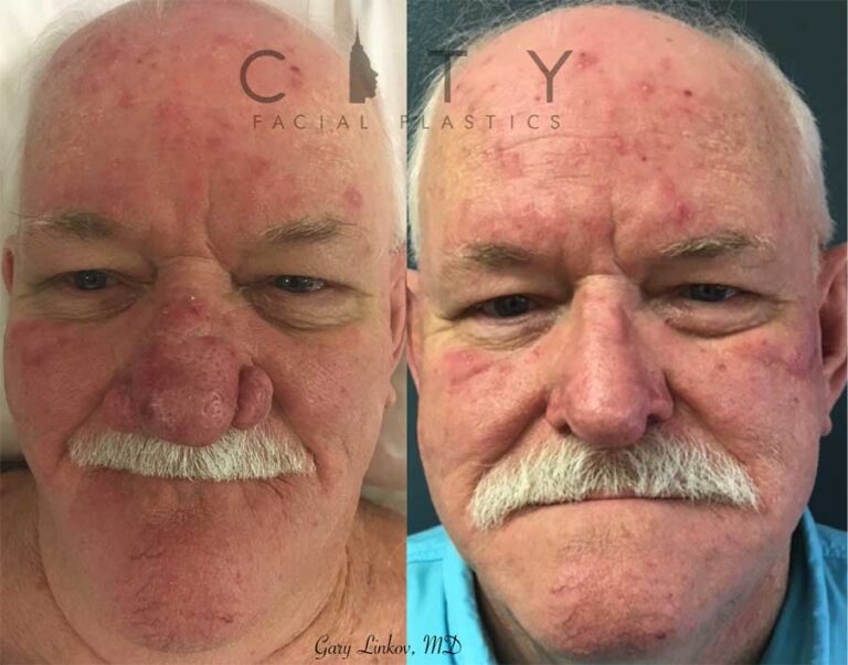 NYC Rhinophyma Treatment New York Rhinophyma Causes UES
