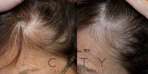 Scalp micropigmentation case 2 | NYC Scalp Micropigmentation Near Me, New York What is SMP?