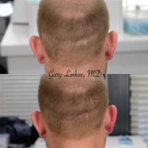 Scalp micropigmentation case 1 | NYC Scalp Micropigmentation Near Me, New York What is SMP?