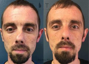 Septoplasty case 2 | New York Septoplasty Repair