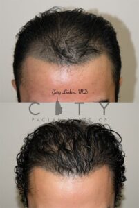 Frontal Chin Down NYC Hair Transplant