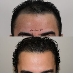 Frontal Main NYC Hair Transplant