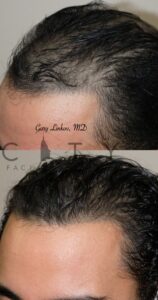 Left Hair Transplant in NYC