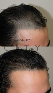 Right Hair Transplant in NYC