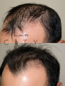 PRP Therapy Upper East Side NYC