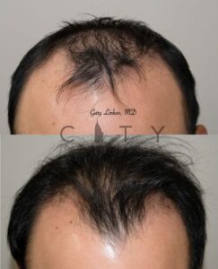 PRP Therapy Upper East Side NYC