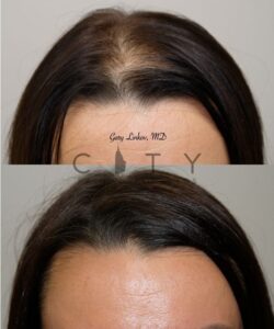 PRP Therapy Upper East Side NYC