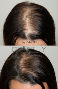 PRP Therapy Upper East Side NYC