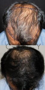 Frontal Chin Down Hair Transplant NYC