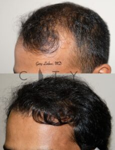 Left Hair Restoration in New York