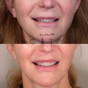 Elelyft Lip Lift Case 11 Frontal Mouth Open Smile