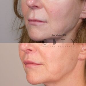 Elelyft Lip Lift Case 11 Left Oblique Mouth Closed
