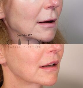 Elelyft Lip Lift Case 11 Right Oblique