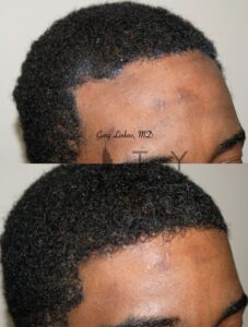 Forehead reduction case 1 right oblique