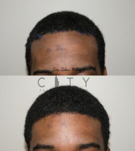 Hair loss treatment PRP Case 3 Frontal