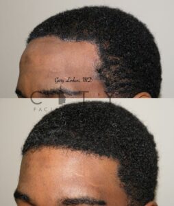 Hair loss treatment PRP Case 3 Left Oblique