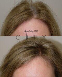 Hair Transplant 7 Frontal