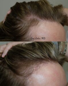 Hair Transplant 7 Right