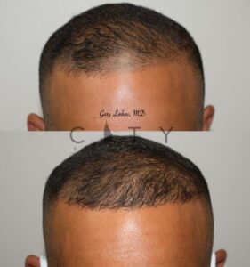 Frontal Hair Transplant in NYC