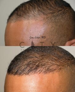 hair transplant new york