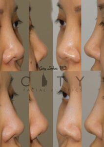 A Non-surgical liquid rhinoplasty Case 3