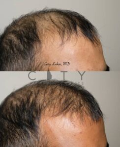 NYC Hair Transplant Right - Dr. Linkov