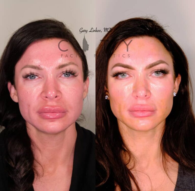 NYC Nostril Reduction Surgery | New York Alar Base Reduction | UES