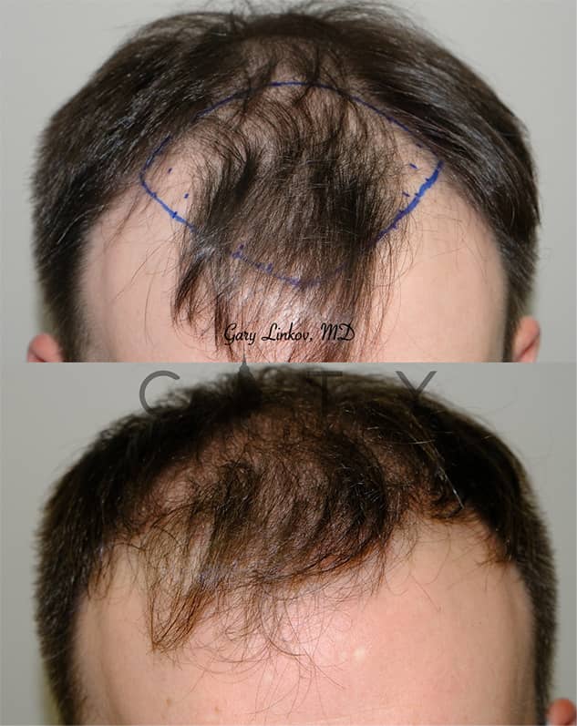 NYC Hair Transplant Before And After Pictures | New York | UES